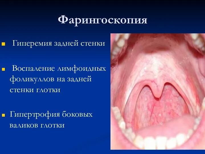 Фарингоскопия Гиперемия задней стенки Воспаление лимфоидных фоликуллов на задней стенки глотки Гипертрофия боковых валиков глотки