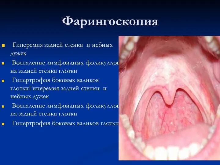 Фарингоскопия Гиперемия задней стенки и небных дужек Воспаление лимфоидных фоликуллов на задней