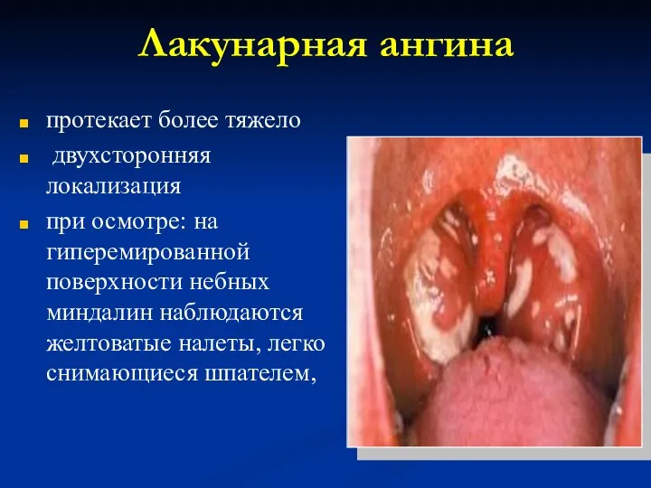 Лакунарная ангина протекает более тяжело двухсторонняя локализация при осмотре: на гиперемированной поверхности