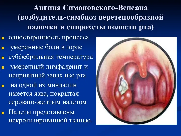 Ангина Симоновского-Венсана (возбудитель-симбиоз веретенообразной палочки и спирохеты полости рта) односторонность процесса умеренные