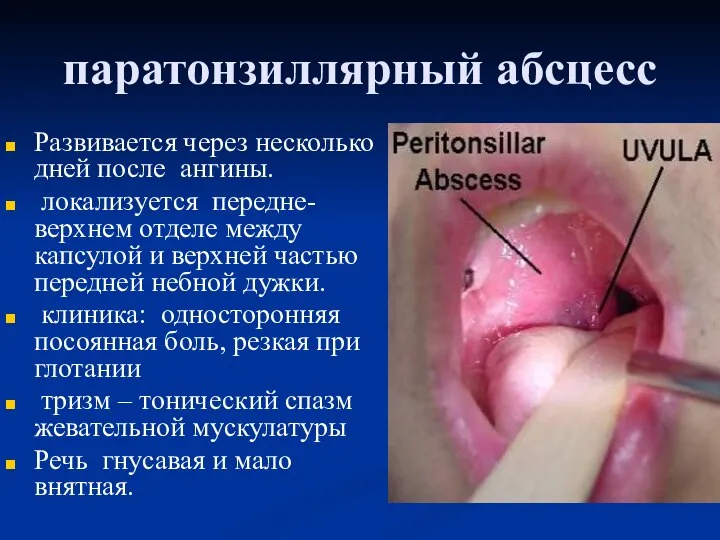 паратонзиллярный абсцесс Развивается через несколько дней после ангины. локализуется передне-верхнем отделе между