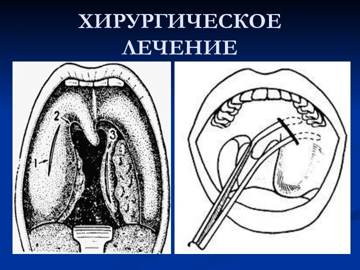 ХИРУРГИЧЕСКОЕ ЛЕЧЕНИЕ