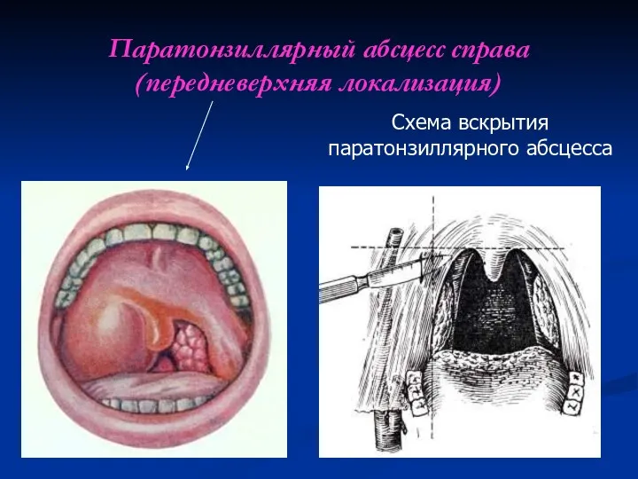 Паратонзиллярный абсцесс справа (передневерхняя локализация)