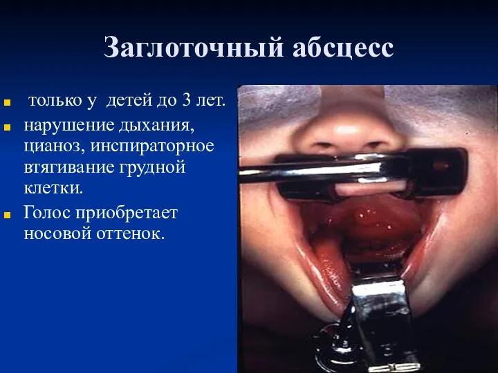 Заглоточный абсцесс только у детей до 3 лет. нарушение дыхания, цианоз, инспираторное