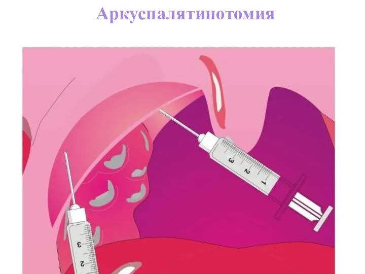 Инфильтрационная анестезия Аркуспалятинотомия