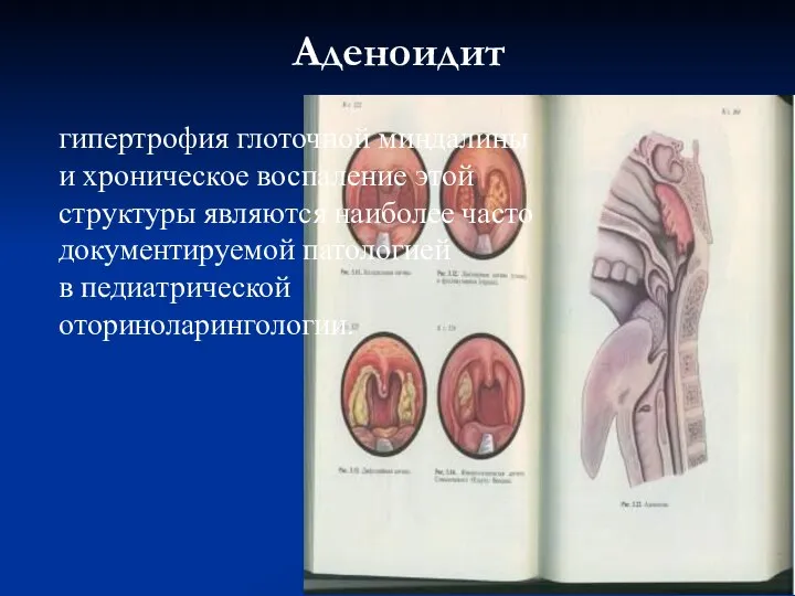 Аденоидит гипертрофия глоточной миндалины и хроническое воспаление этой структуры являются наиболее часто