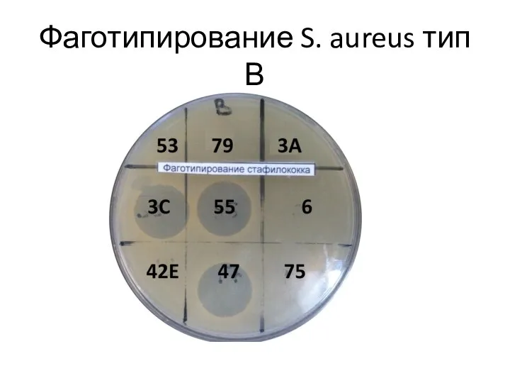 Фаготипирование S. aureus тип В