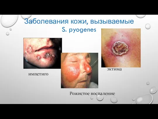 эктима Рожистое воспаление импетиго Заболевания кожи, вызываемые S. pyogenes
