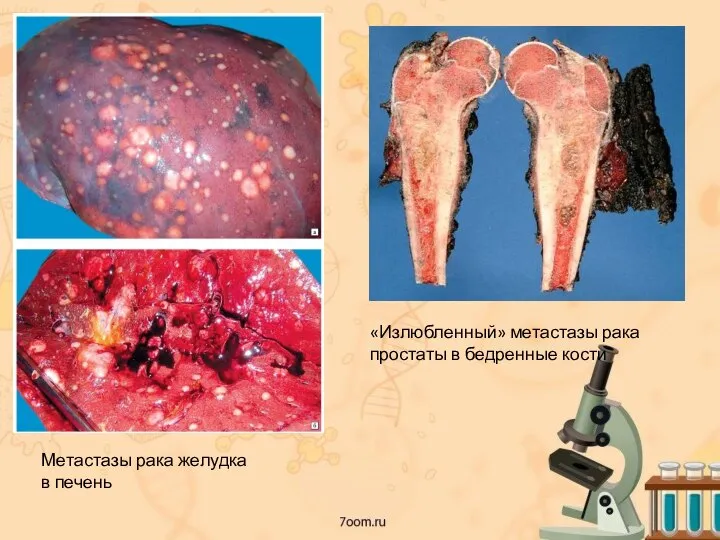 Метастазы рака желудка в печень «Излюбленный» метастазы рака простаты в бедренные кости