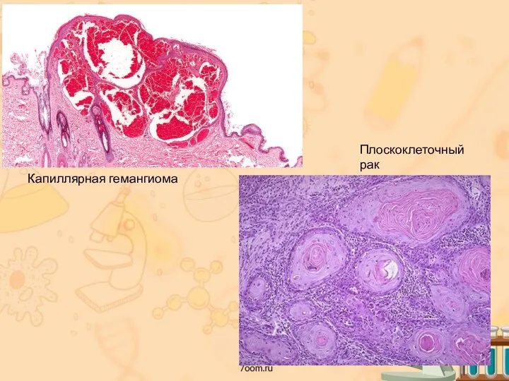 Капиллярная гемангиома Плоскоклеточный рак