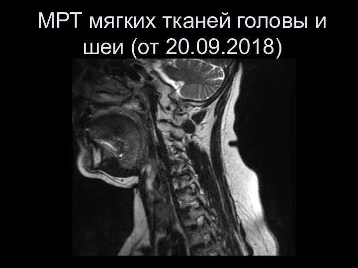 МРТ мягких тканей головы и шеи (от 20.09.2018)