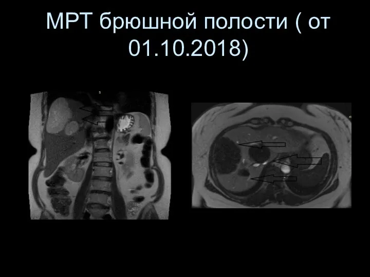 МРТ брюшной полости ( от 01.10.2018)