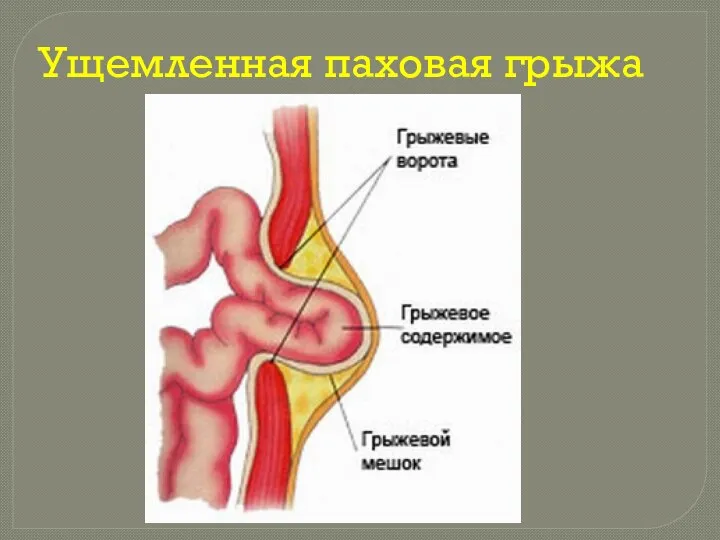 Ущемленная паховая грыжа