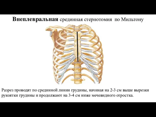 Внеплевральная срединная стернотомия по Мильтону Разрез проводят по срединной линии грудины, начиная