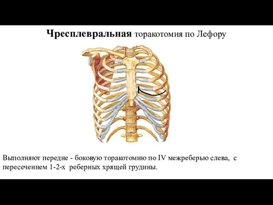 Чресплевральная торакотомия по Лефору Выполняют передне - боковую торакотомию по IV межреберью