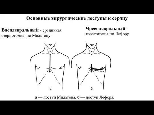 Основные хирургические доступы к сердцу Внеплевральный - срединная стернотомия по Мильтону а