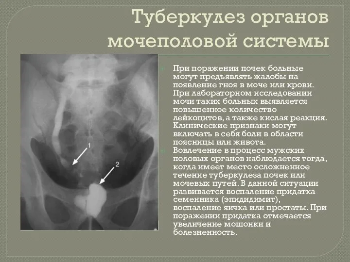 Туберкулез органов мочеполовой системы При поражении почек больные могут предъявлять жалобы на