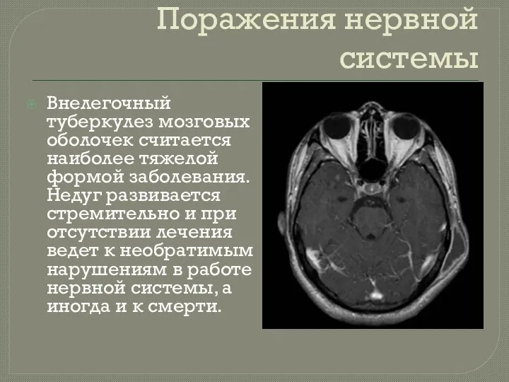 Поражения нервной системы Внелегочный туберкулез мозговых оболочек считается наиболее тяжелой формой заболевания.