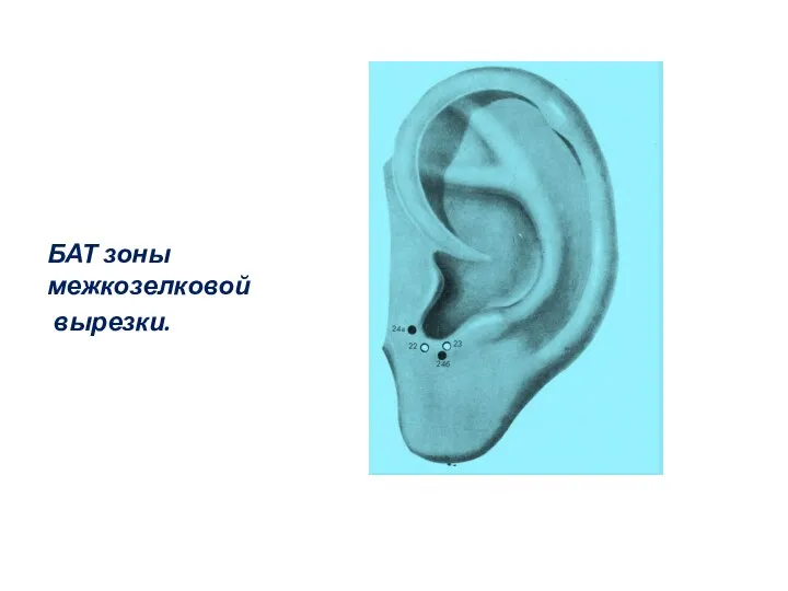 БАТ зоны межкозелковой вырезки.