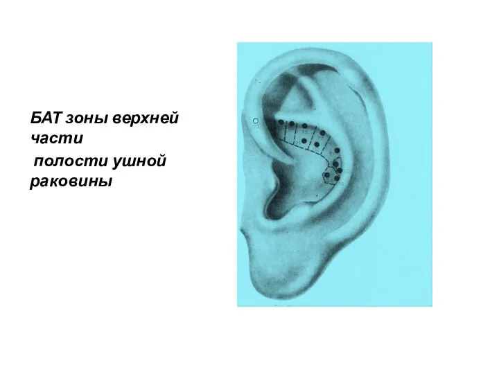 БАТ зоны верхней части полости ушной раковины
