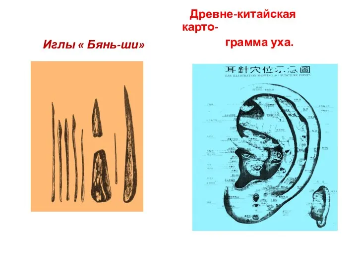 Иглы « Бянь-ши» Древне-китайская карто- грамма уха.