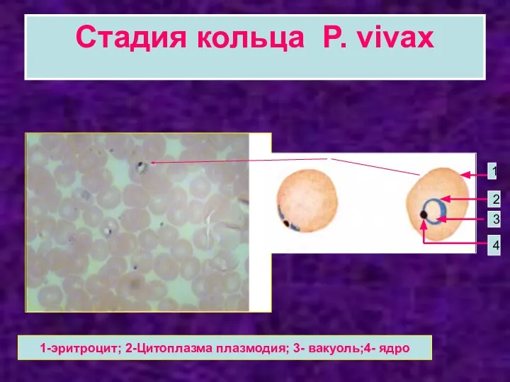 Стадия кольца P. vivax 1 2 3 4 1-эритроцит; 2-Цитоплазма плазмодия; 3- вакуоль;4- ядро