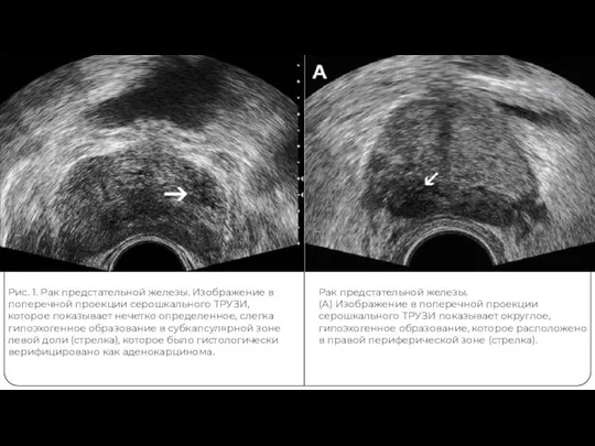 Рак предстательной железы. (А) Изображение в поперечной проекции серошкального ТРУЗИ показывает округлое,