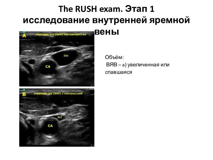 The RUSH exam. Этап 1 исследование внутренней яремной вены Объём: ВЯВ – a) увеличенная или спавшаяся