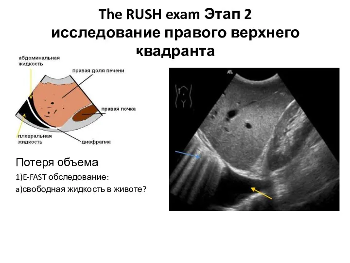 The RUSH exam Этап 2 исследование правого верхнего квадранта Потеря объема 1)E-FAST