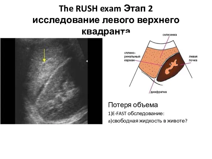 The RUSH exam Этап 2 исследование левого верхнего квадранта Потеря объема 1)E-FAST