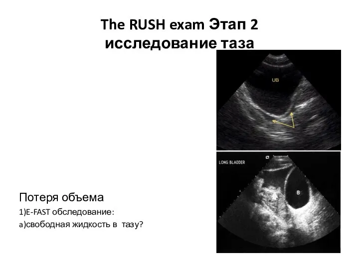 The RUSH exam Этап 2 исследование таза Потеря объема 1)E-FAST обследование: a)свободная жидкость в тазу?