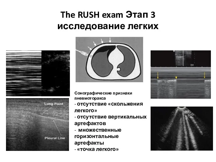 The RUSH exam Этап 3 исследование легких Сонографические признаки пневмоторакса - отсутствие