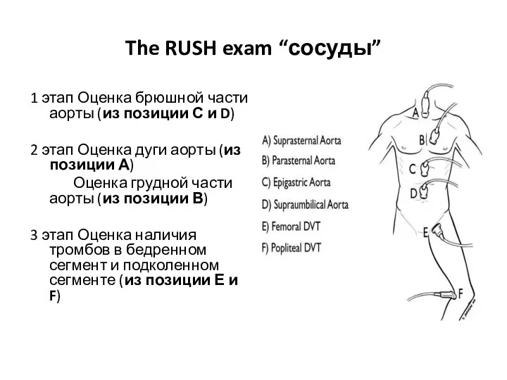 The RUSH exam “сосуды” 1 этап Оценка брюшной части аорты (из позиции