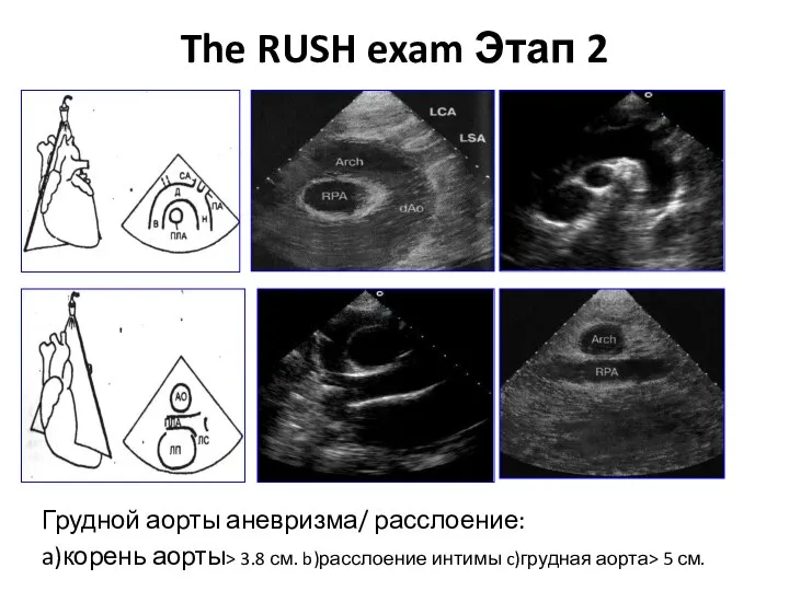 The RUSH exam Этап 2 Грудной аорты аневризма/ расслоение: a)корень аорты> 3.8