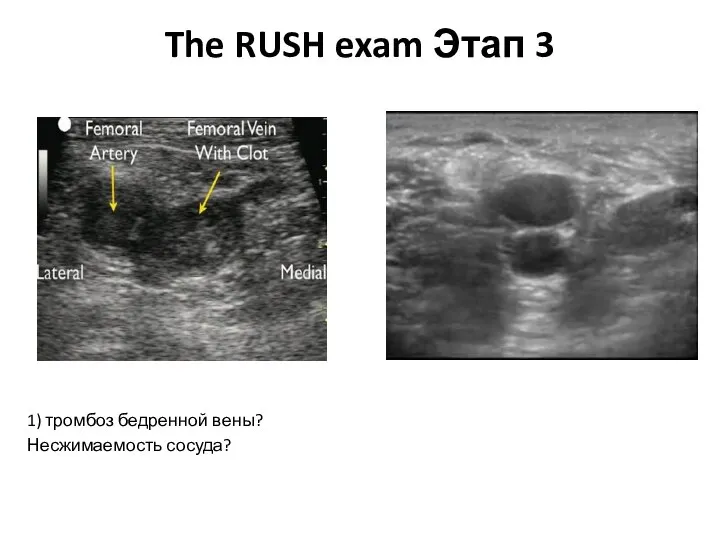 The RUSH exam Этап 3 1) тромбоз бедренной вены? Несжимаемость сосуда?