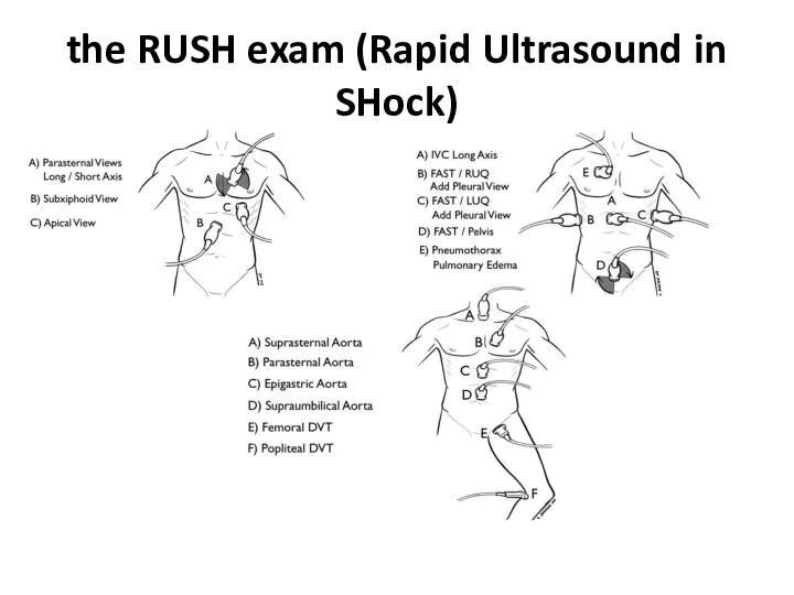 the RUSH exam (Rapid Ultrasound in SHock)