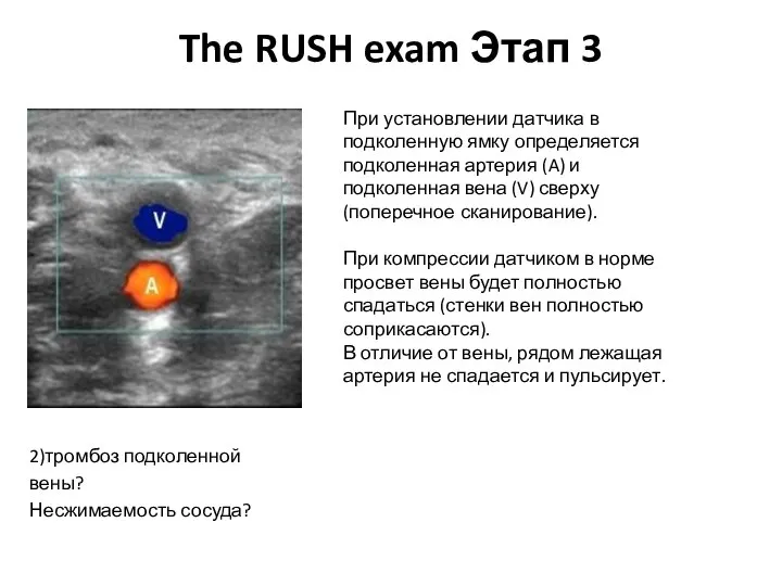 The RUSH exam Этап 3 2)тромбоз подколенной вены? Несжимаемость сосуда? При установлении