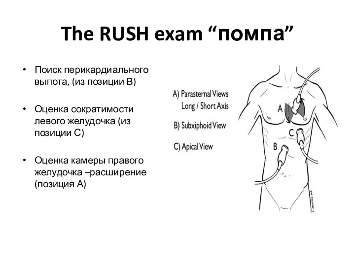 The RUSH exam “помпа” Поиск перикардиального выпота, (из позиции В) Оценка сократимости
