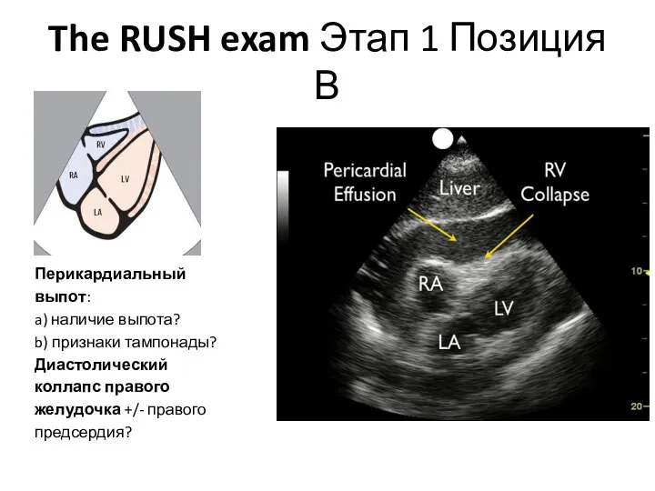 The RUSH exam Этап 1 Позиция В Перикардиальный выпот: a) наличие выпота?