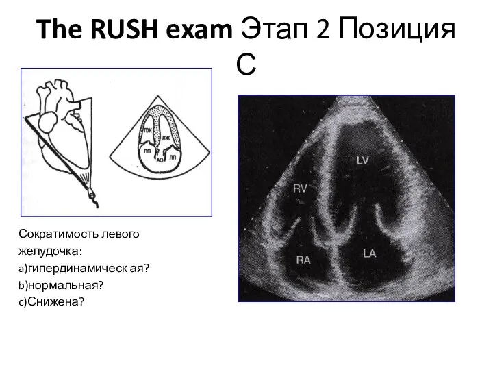 The RUSH exam Этап 2 Позиция С Сократимость левого желудочка: a)гипердинамическ ая? b)нормальная? c)Снижена?