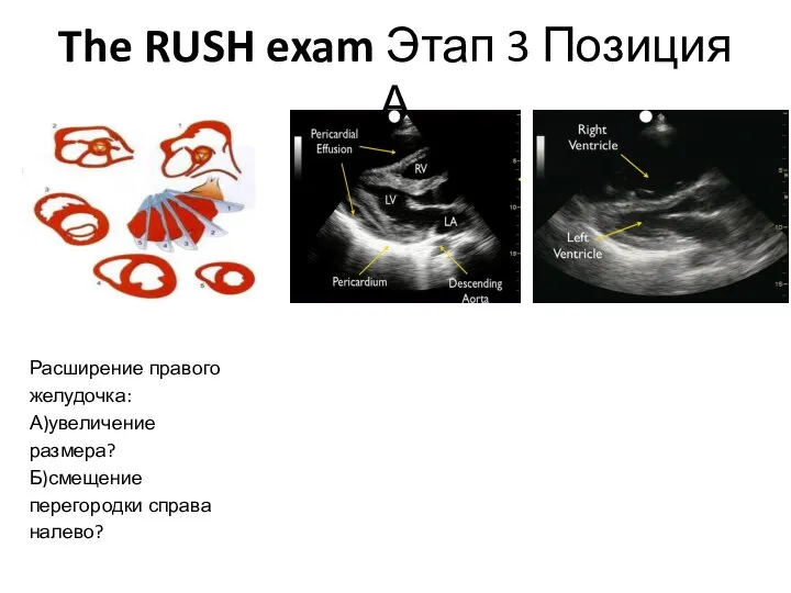 The RUSH exam Этап 3 Позиция А Расширение правого желудочка: А)увеличение размера? Б)смещение перегородки справа налево?