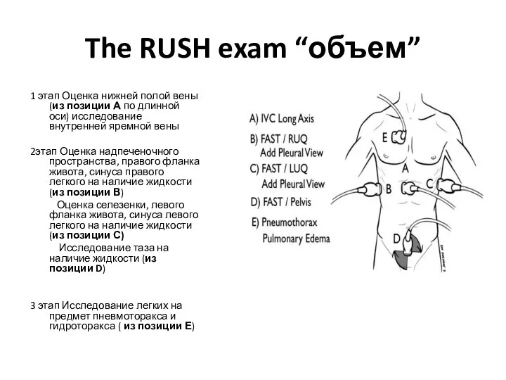 The RUSH exam “объем” 1 этап Оценка нижней полой вены (из позиции