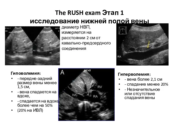 The RUSH exam Этап 1 исследование нижней полой вены Гиповолемия: - передне-задний