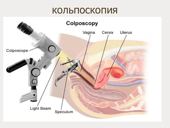 кольпоскопия