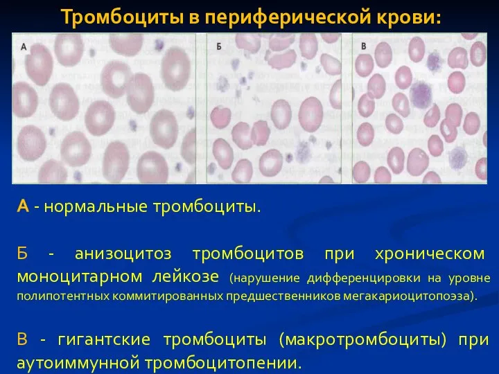 А - нормальные тромбоциты. Б - анизоцитоз тромбоцитов при хроническом моноцитарном лейкозе