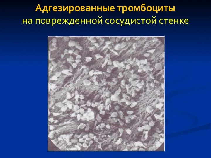 Адгезированные тромбоциты на поврежденной сосудистой стенке