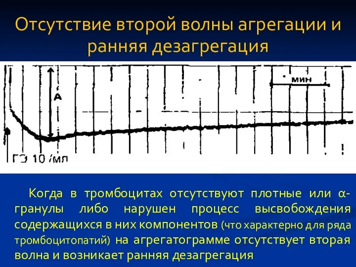 Отсутствие второй волны агрегации и ранняя дезагрегация Когда в тромбоцитах отсутствуют плотные