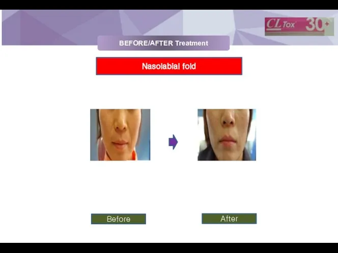 BEFORE/AFTER Treatment Nasolabial fold Before After