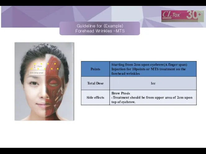 Guideline for (Example) Forehead Wrinkles -MTS