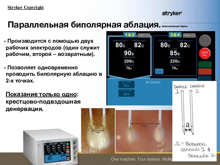 Параллельная биполярная аблация. Производится с помощью двух рабочих электродов (один служит рабочим,